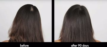 Female Hair Loss Treatment Toronto