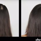 Female Hair Loss Treatment Toronto