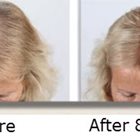 Hair Growth Products After Chemo